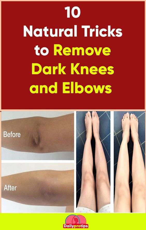 10 Natural Tricks to Remove Dark Knees and Elbows in 2020 ...