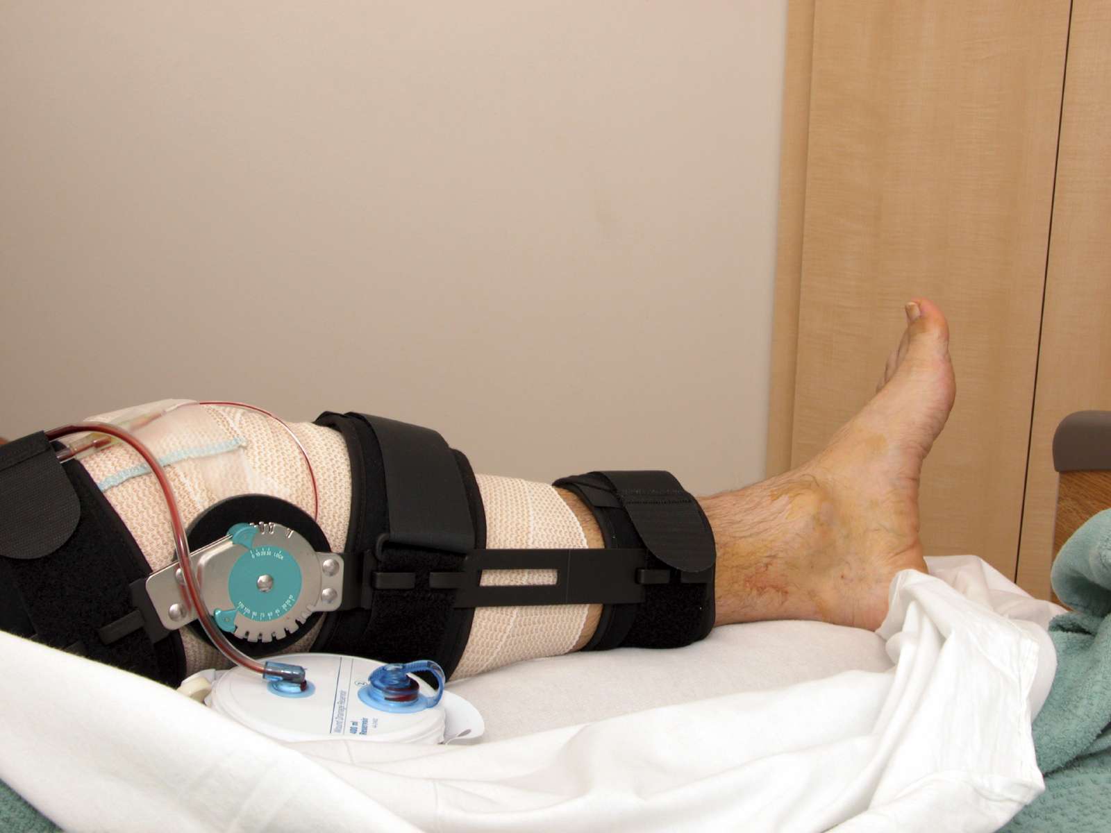 ACL Surgery Recovery Timeline