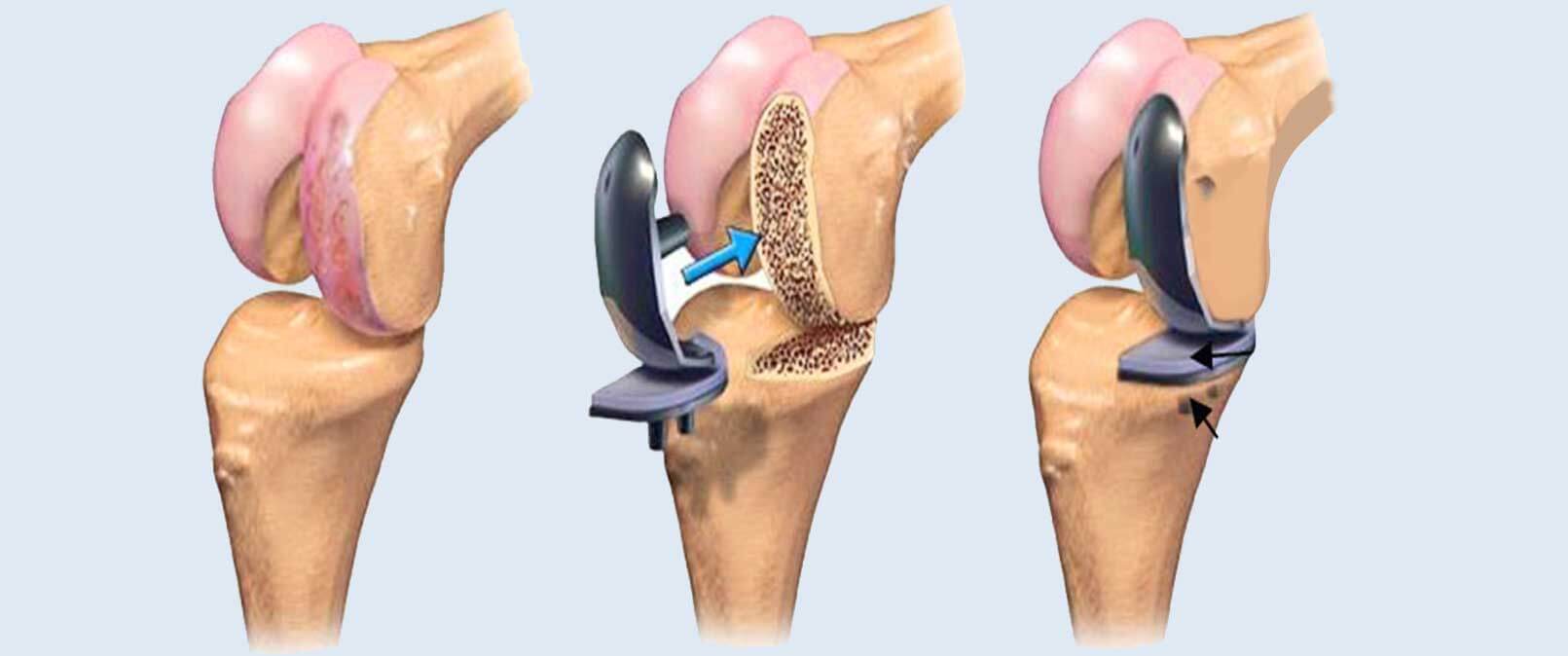 Best knee replacement surgeon in hyderabad