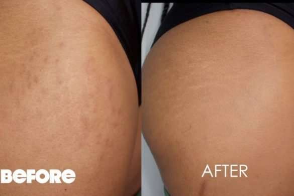 Causes and How to Remove Stretch marks on Knees