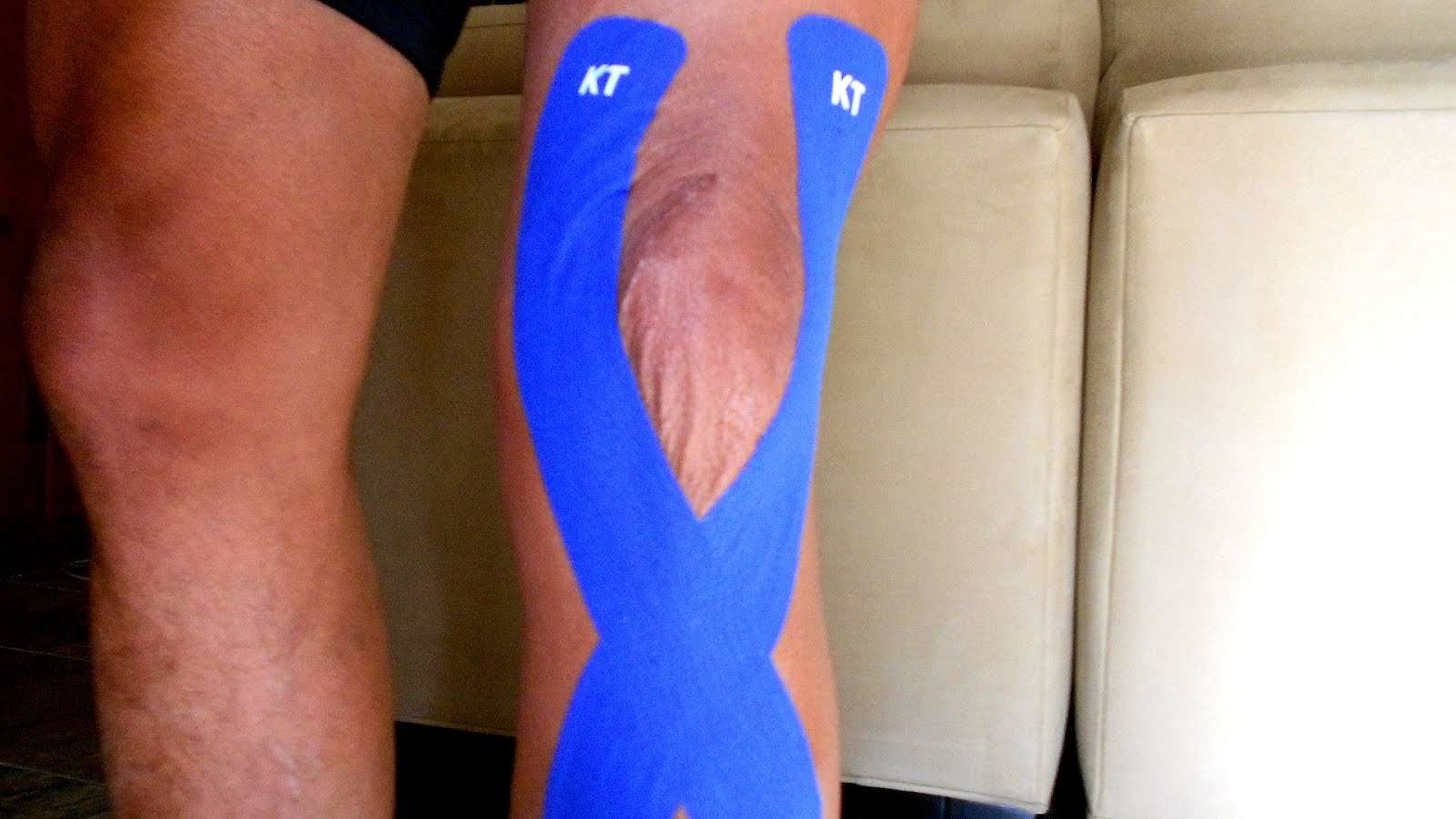 How Long Does Swelling Last After Knee Replacement Surgery ...