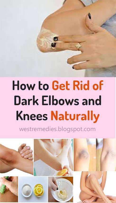 How to Get Rid of Dark Elbows and Knees Naturally
