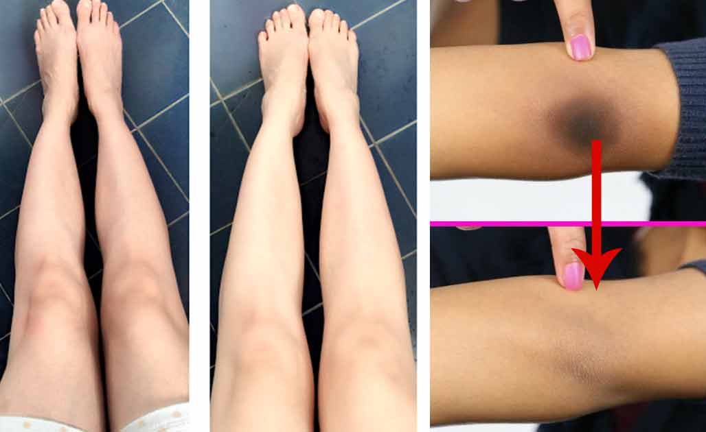 How to get rid of Dark Knees and Elbows