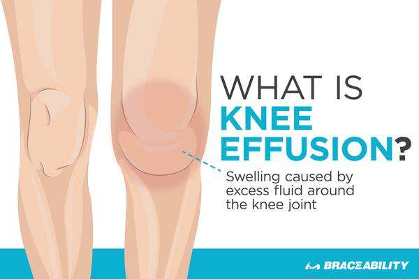 How to get rid of fluid on the kneecap