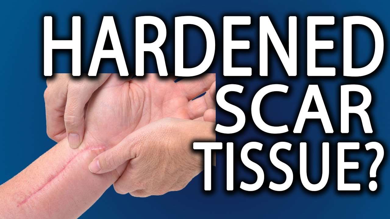 How to Get Rid of Hardened Scar Tissue