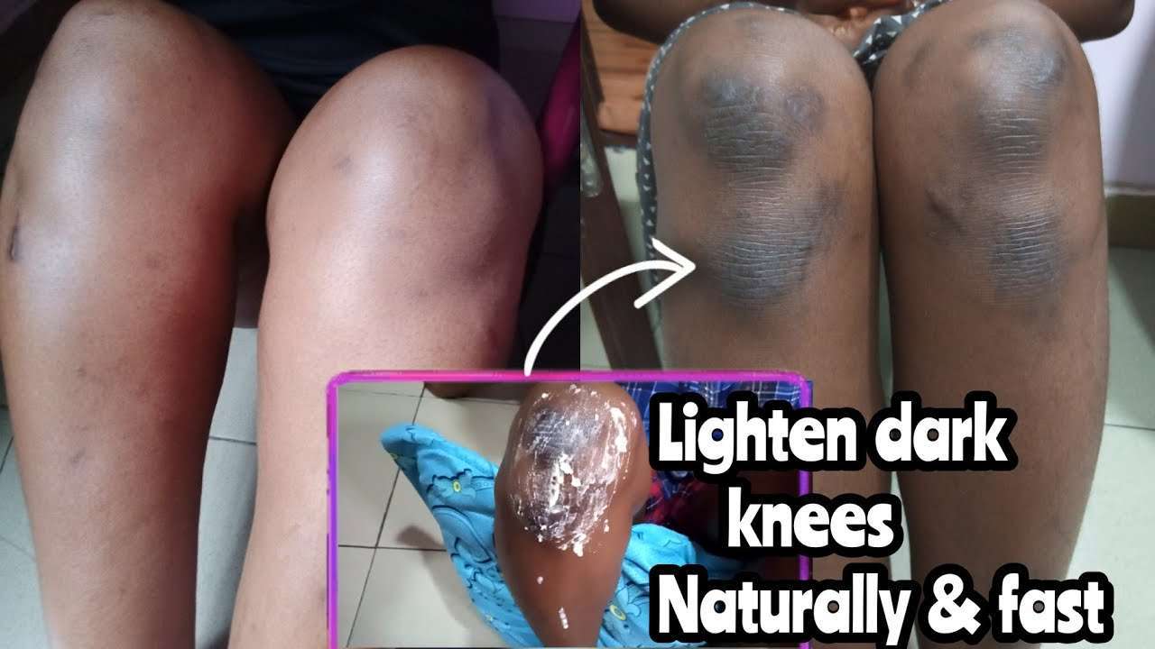 How to lighten dark knees and elbows fast and Naturally ...