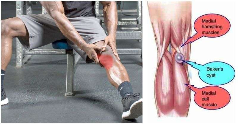 How To Treat A Pulled Tendon Behind The Knee