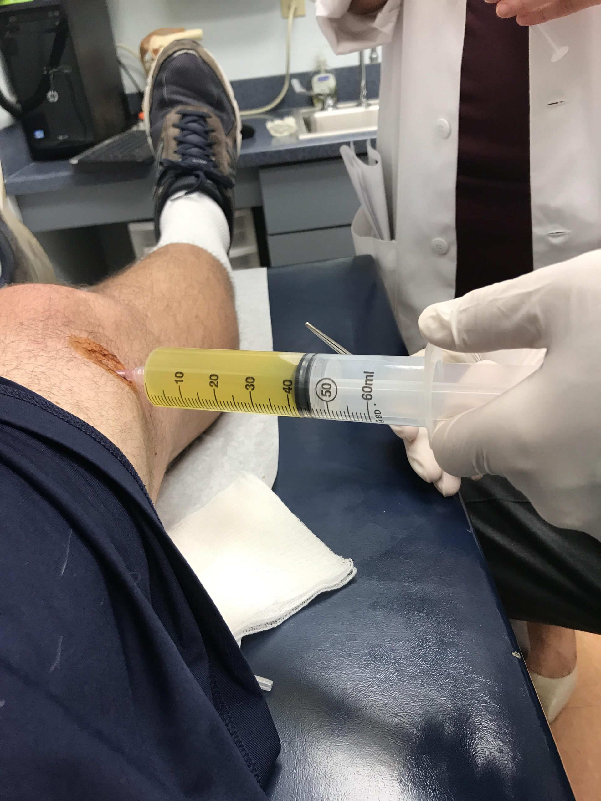 Knee fluid drained : KneeInjuries