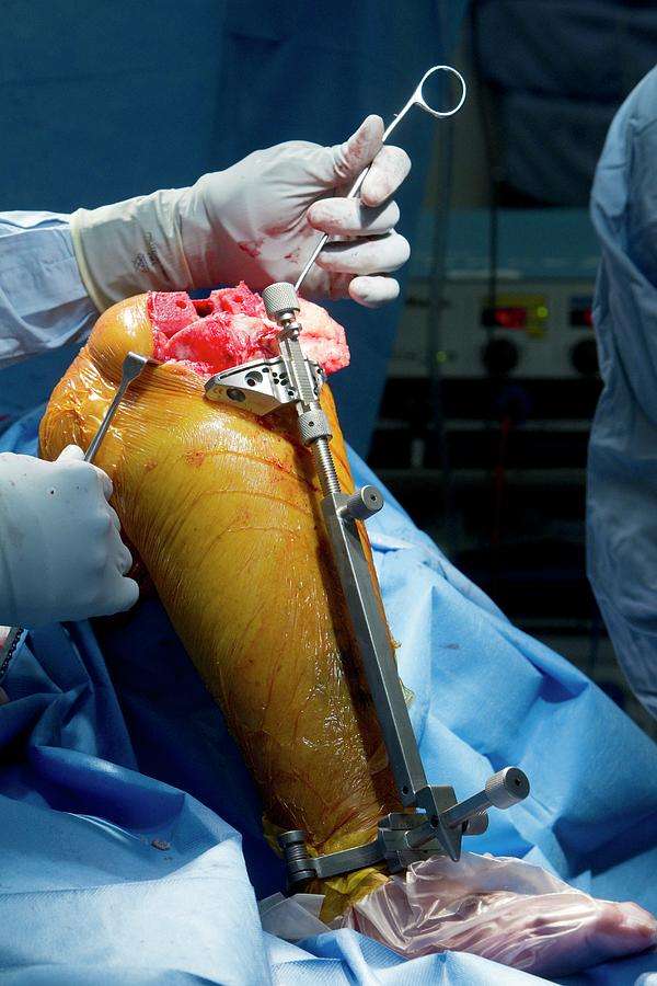Knee Replacement Surgery Photograph by Mark Thomas/science Photo Library
