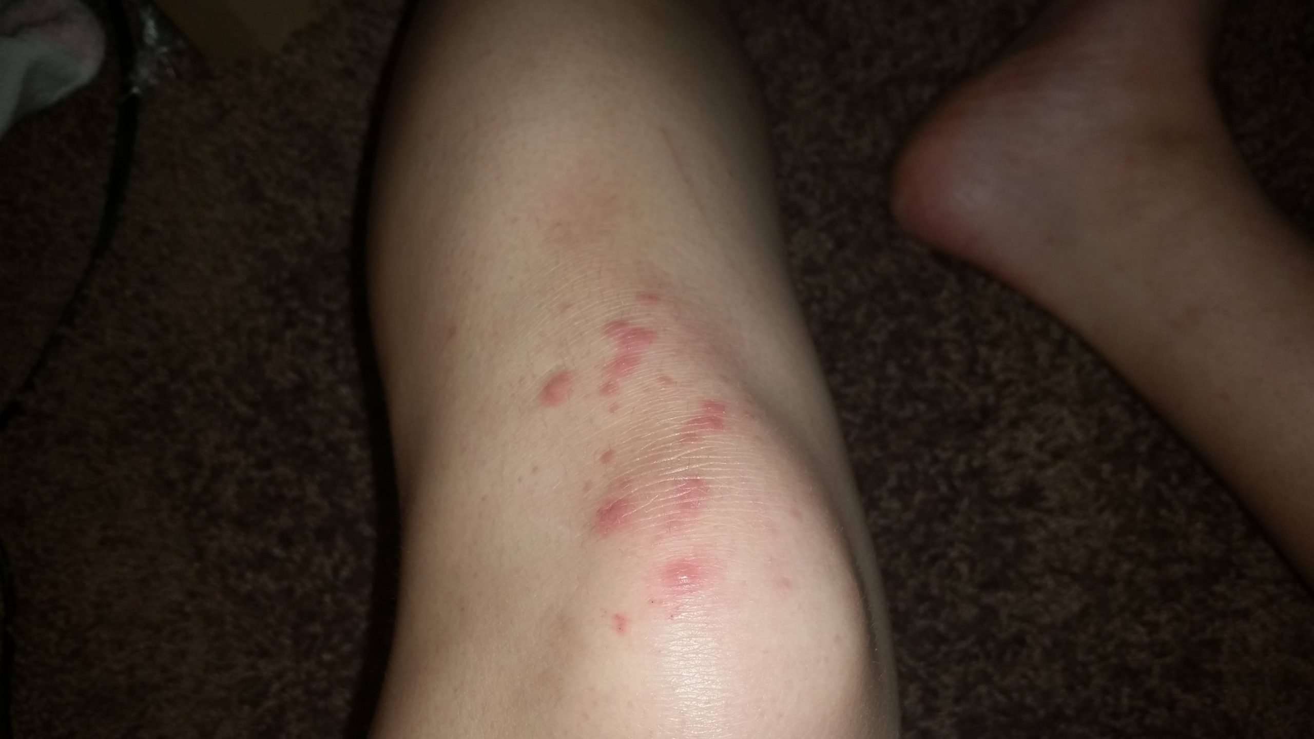 Red itchy then sore bumps on elbows knees finger joints ...