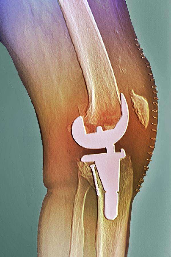 Total Knee Replacement Photograph by Zephyr/science Photo ...