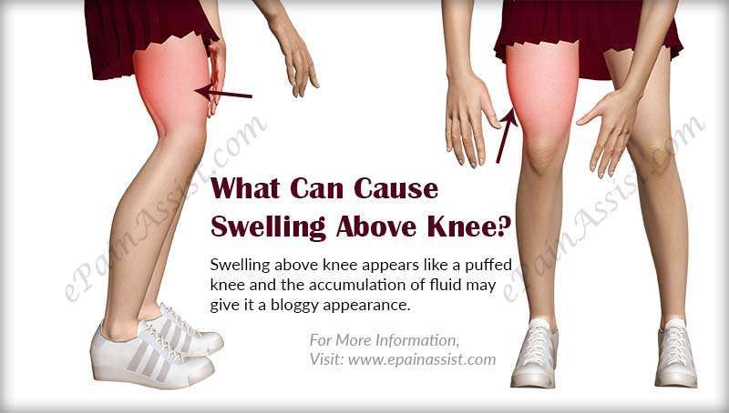 What Can Cause Swelling Above Knee &  What is its Treatment?